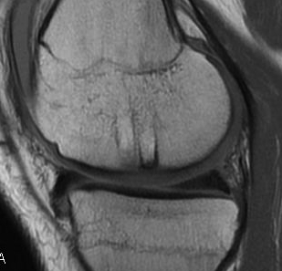 Mosaicplasty Harvest Site MRI